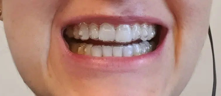 nakładki Invisalign
